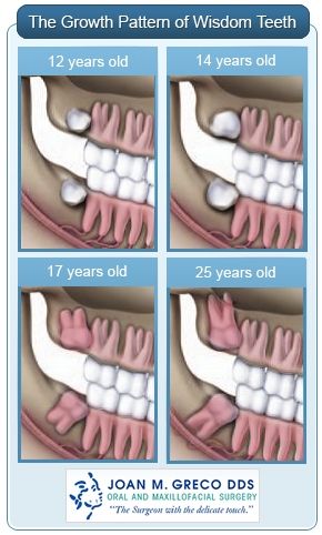 normal wisdom teeth growth