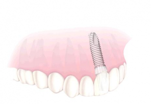 Single Tooth Implant 