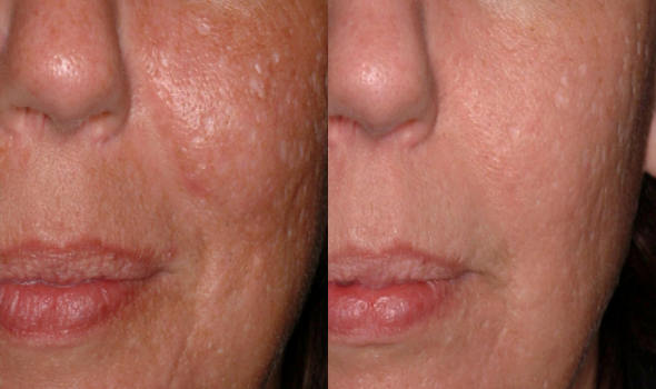 Acne Scar Removal with CO2 Laser Treatment - Before & After 